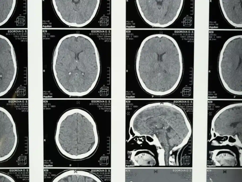 Scanner d'une atrophie cortico sous corticale