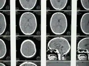 Scanner d'une atrophie cortico sous corticale